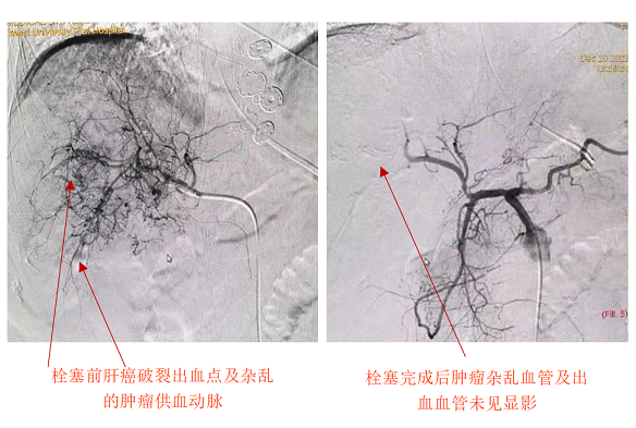 肝癌破裂大出血命悬一线——六合彩生肖
急诊介入止血化险为夷